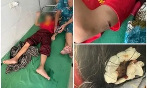 Trường học lên tiếng vụ học sinh lớp 5 nghi bị cha dượng bạo hành