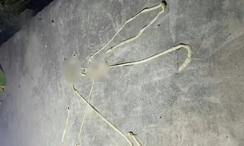 Bị rối loạn tiêu hóa, người đàn ông phát hiện "vật thể lạ" dài gần 10m