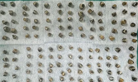 Đau bụng đi khám, người phụ nữ 40 tuổi sốc khi bác sĩ gắp ra thứ "đáng sợ" bên trong