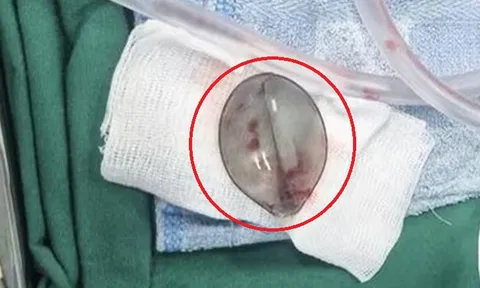 Bé 4 tuổi nôn ra máu, bác sĩ phát hiện thứ "đáng sợ" bên trong