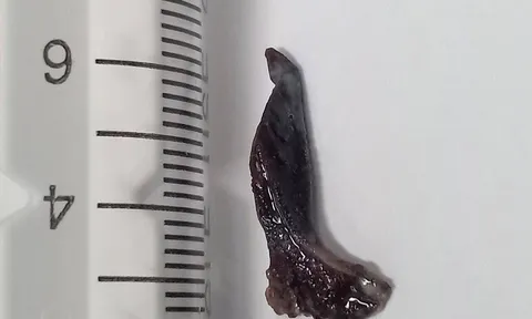 Lấy thành công dị vật “bỏ quên” trong phế quản người đàn ông suốt 10 năm