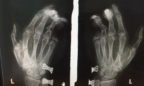 Điện thoại phát nổ khi đang sạc khiến nam thanh niên bị dập nát bàn tay