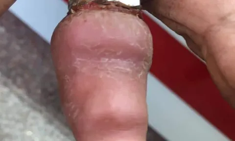 Bà cụ 75 tuổi lấy ốc bulông làm nhẫn suýt mất ngón tay