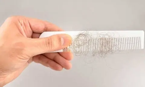 Nỗi ám ảnh rụng tóc và 5 thói quen cần từ bỏ