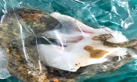 Bé gái tắc ruột vì hội chứng thích ăn tóc