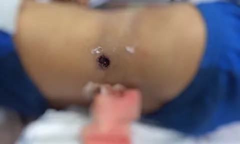 Ôm súng đi săn, nam thanh niên ngã xe máy bị súng bắn thấu bụng