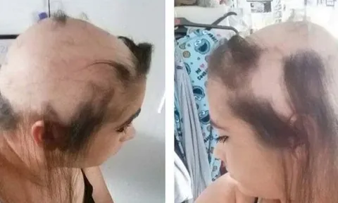 Cô gái bị rụng gần hết tóc vì thất tình