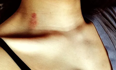 Đừng coi thường những vết bầm đột nhiên xuất hiện trên da, bệnh nghiêm trọng đấy!