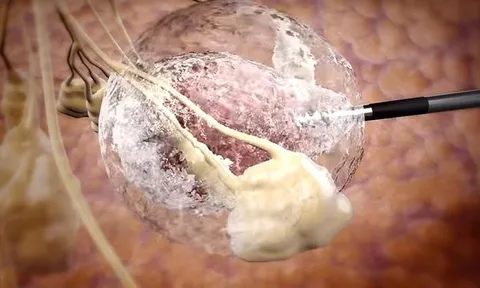 Diệt khối u bằng công nghệ nhiệt động