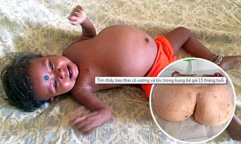 Tìm thấy bào thai có xương và tóc trong bụng bé gái 15 tháng tuổi